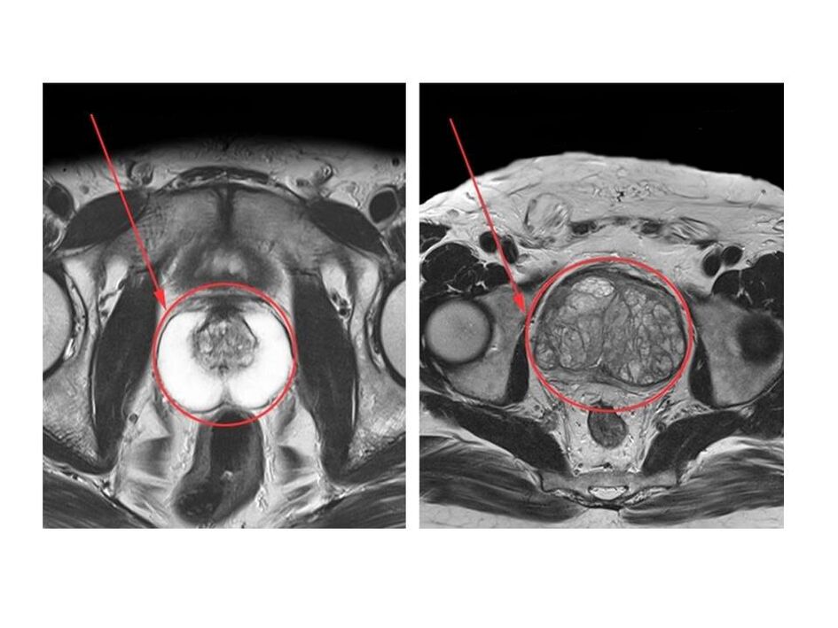 Vergelijking van een gezonde (links) en ontstoken (rechts) prostaat op MRI-beelden